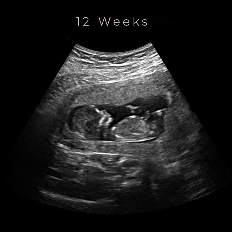 Ultrasound